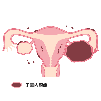 子宮内膜症のイメージ画像です。