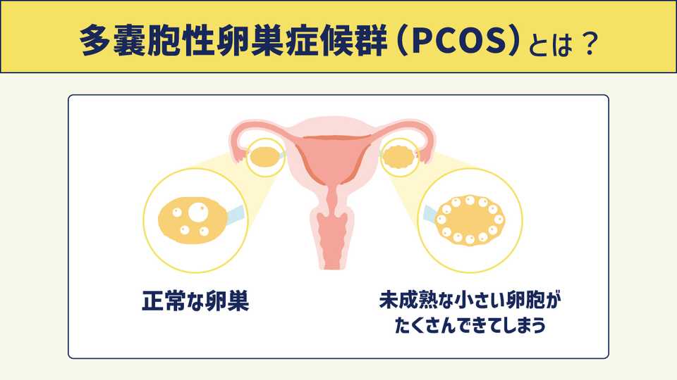 多嚢胞性卵巣症候群(PCOS)とは?