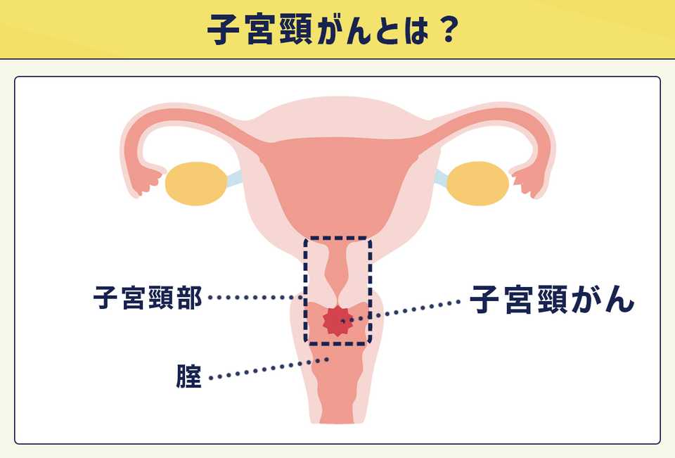 子宮頸がんとは？