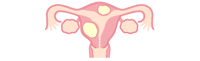 子宮筋腫のイメージ画像です。