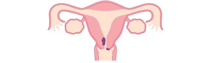 子宮頸がんのイメージ画像です。