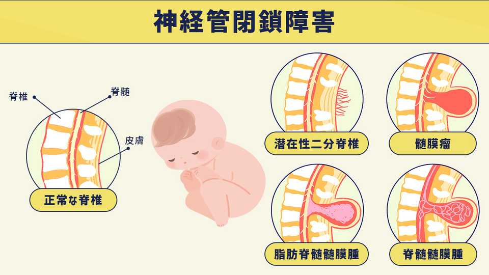 神経管閉鎖障害