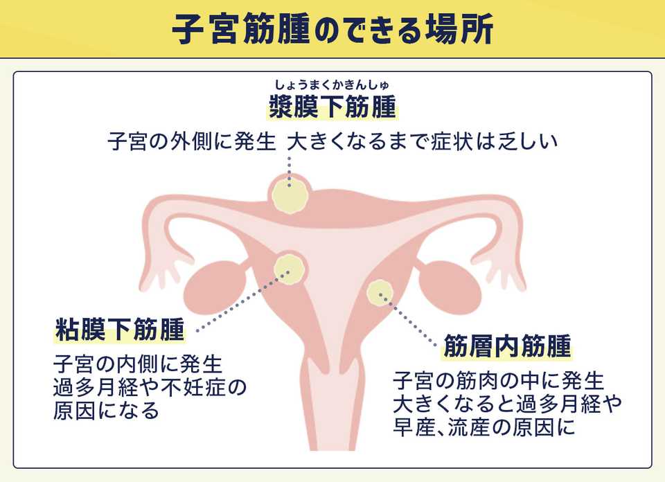 子宮筋腫のできる場所
