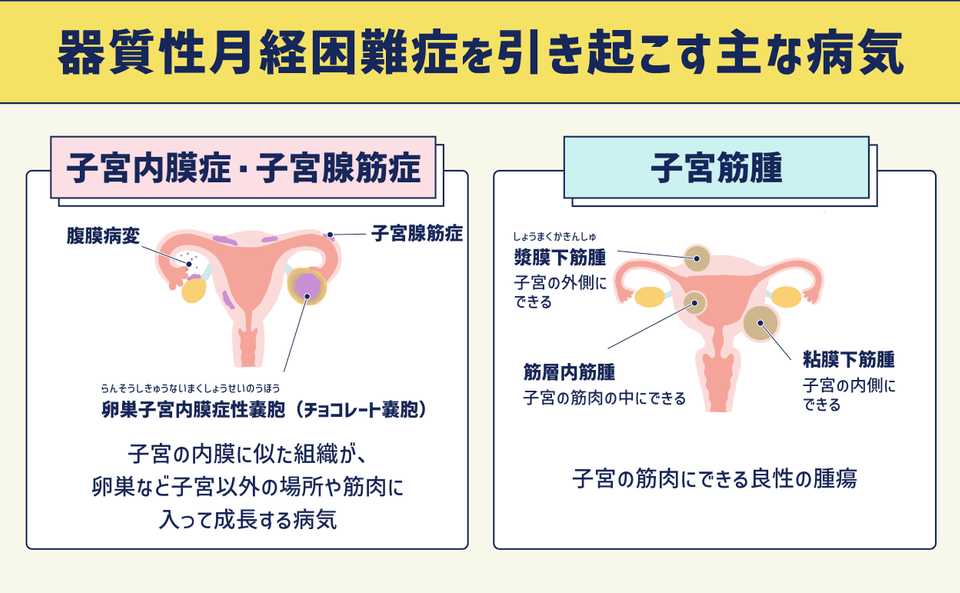 器質性月経困難症を引き起こす主な病気