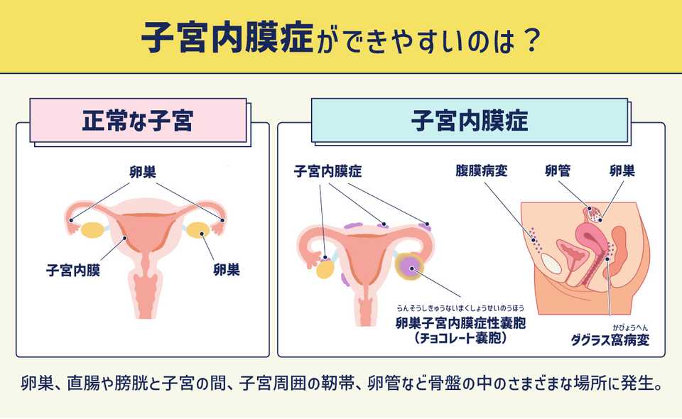子宮内膜症ができやすいのは