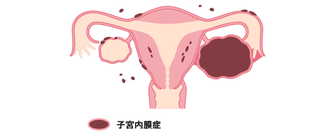 子宮内膜症のイメージ画像です。